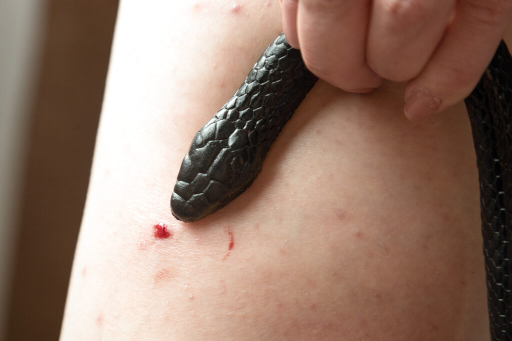 Venomous snake bite in a man's leg